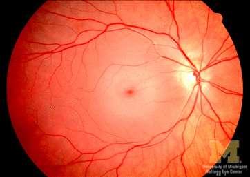 Thrombosis or embolus Sudden onset of painless unilateral vision loss Fundoscopy reveals pallor of the retina with a cherry red