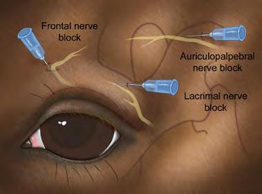 The auriculopalpebral nerve (motor nerve to the orbicularis oculi muscle) can be palpated under the skin and blocked with 2-3 ml of lidocaine or mepivicaine (Carbocaine) just lateral to the highest