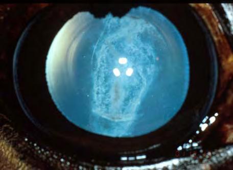 There are a number of lens opacities which may be regarded as normal variations: prominent lens sutures, the point of attachment of the hyaloid vessel, refractive concentric rings, fine "dustlike"