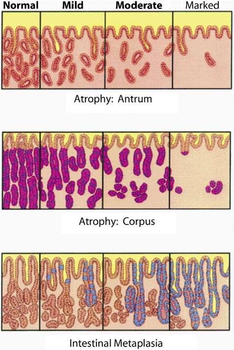 Assessment of atrophy Human Pathology 2011;