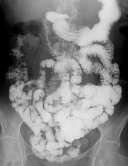 GASTROESOPHAGEAL REFLUX EVALUATION GI X-ray Studies to Evaluate GER