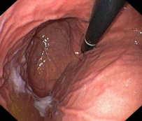 Endoscopic therapies Helicobacter Pylori - Gastritis Cause of abdominal pain, gastritis, ulcer disease and associated with