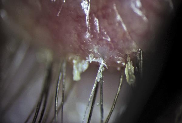 Staph aureus bacteria Flakes