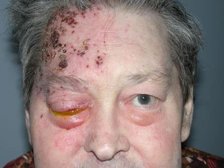 Herpes Zoster Ophthalmicus Caused by the herpes zoster virus (shingles) Respects the midline Usually found in