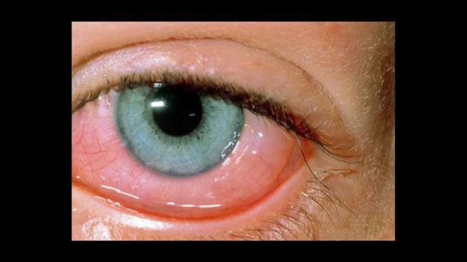 Allergic Red Eye Allergy to some agent Seasonal allergies Giant papillary conjunctivitis Vernal conjunctivitis These are all