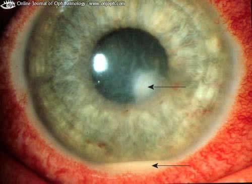Corneal Ulcer Ulcers should always be seen by an eye care provider Generally have true photophobia and lots of inflammation