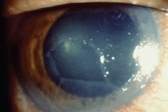 Recurrent Corneal Erosion History of trauma Hallmark is Lots of tearing, pain, foreign body sensation Treatment artificial tears, hypertonic solution such as 5% NaCl solution or ointment