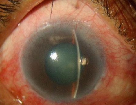Acute Angle Closure Characterized by nausea, red eye on the affected side, blurred vision A TRUE EYE EMERGENCY Check intraocular