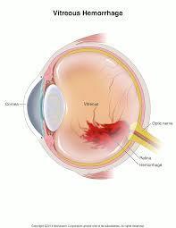 44 Vitreous Hemorrhage Causes Most commonly: proliferative diabetic retinopathy Posterior vitreous detachment Retinal