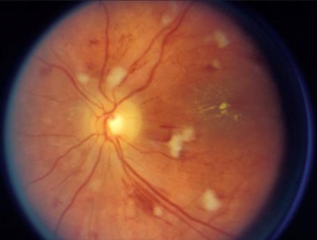 Hypertensive Retinopathy 45 A disease of the retinal arteries Narrowing of arteriolar lumen compresses the veins Arteriolosclerotic retinopathy vs hypertensive retinopathy Findings
