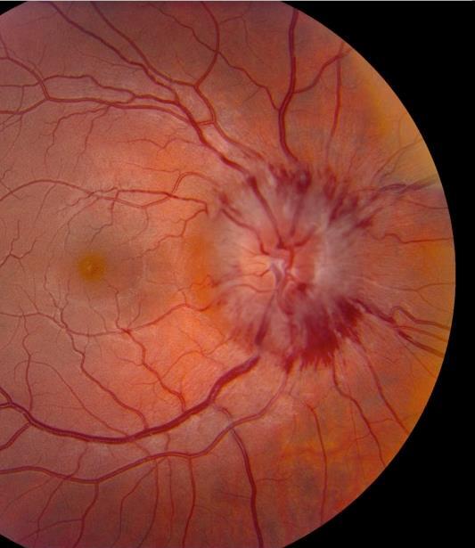 Hypertensive Retinopathy 46 Detection and diagnosis: routine dilated eye exams Symptoms Nothing Blurred vision