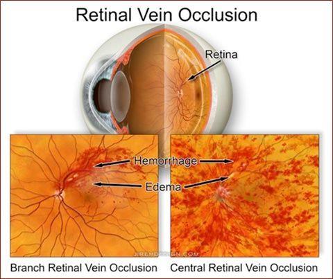 Retinal vein occlusions Branch retinal vs central retinal Symptoms Nothing Blurred vision Etiology: arteriolar compression A/V nick Blood and