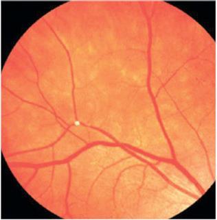 Branch retinal artery occlusion Branch retinal artery occlusion vs central retinal artery occlusion Symptoms Transient monocular vision loss Loss of