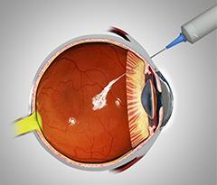 Macular Degeneration Treatment AREDS 2 vitamins for intermediate severe stage, in hopes of slowing progression of geographic atrophy of