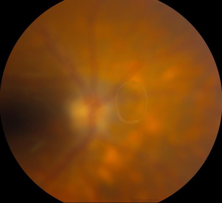 Flashes and Floaters Differentials: Posterior vitreous