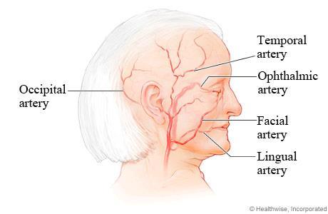 Giant cell arteritis Inflammation of the medium and large arterioles in the body Most commonly affects the temporal artery AKA temporal arteritis In the eye, causes any number of