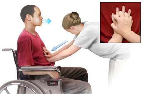 Quad Coughing An abdominal thrust that is coordinated with a patients cough effort.