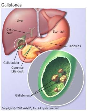Gallstones Small, hard masses form in the gallbladder, caused by the formation of crystals in the bile Contributing factors: Smoking, excessive alcohol use,
