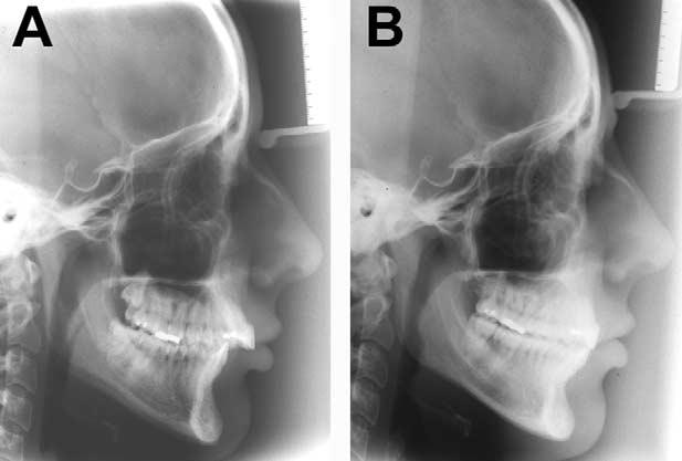 American Journal of Orthodontics and Dentofacial Orthopedics Volume 126, Number 2 Ruf and Pancherz 149 Fig 7.