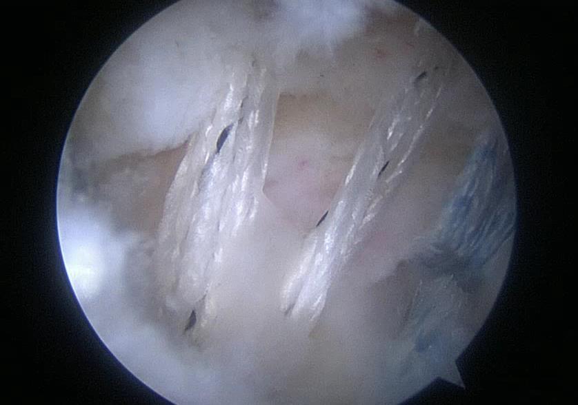 Case 4: 63 YOM chronic shoulder pain tear From inside the joint and looking cranially, the tear of the supraspinatus tendon is seen as is the