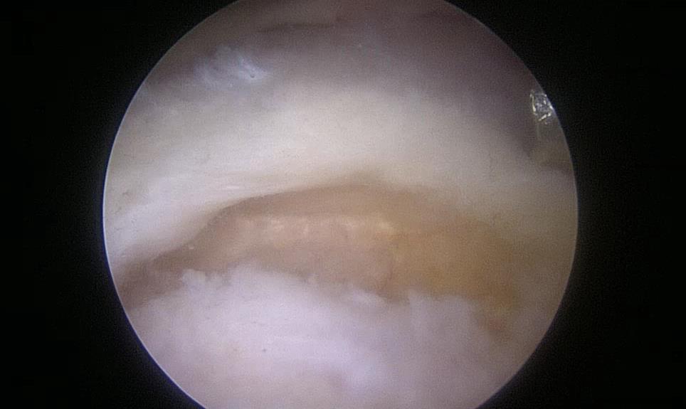 Through the tear and from inside the joint, the subacromial bursa can be seen (black arrow).