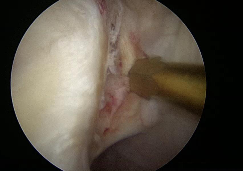 AKA ALPSA lesion) Sagittal oblique  as part of the ALPSA lesion.