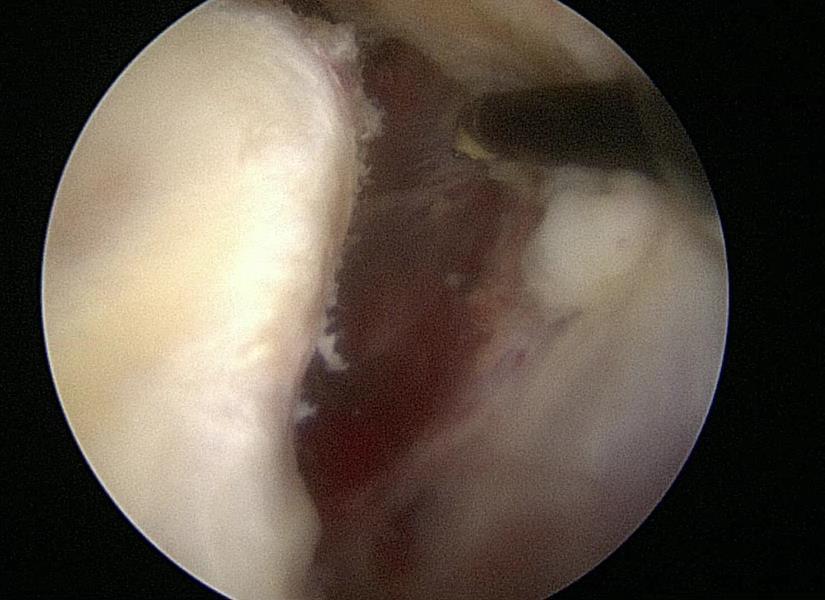 Glenoid Probe pulls back tear further to show the periosteum is