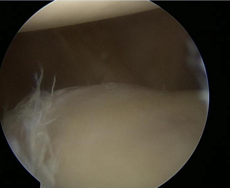 Arthroscopy shows fraying of the direct posterior labrum (which was debrided at the