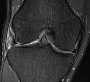 Case 2: 21YOM with pain at the lateral joint