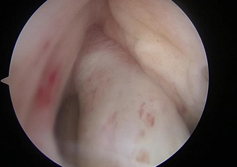 plateau Lateral meniscus tear (blurry image