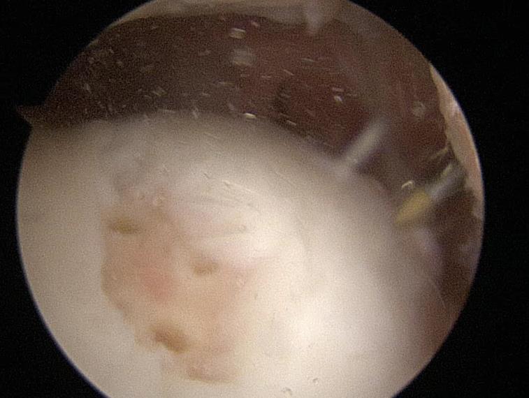 Case 3: 18 YOM with medial knee pain found to have large unstable OCL in MFC (top left).