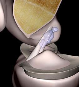 Anterior Cruciate Ligament (ACL) INTERPRETATION PITFALLS INTRALIGAMENTOUS GANGLION CYSTS Cysts are located in the proximal-middle portions of intact ACL Herniation of synovial tissue