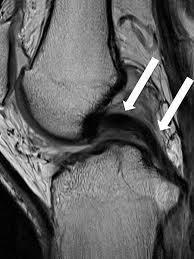 Posterior Cruciate Ligament (PCL) Intra-articular, extra-synovial structure.