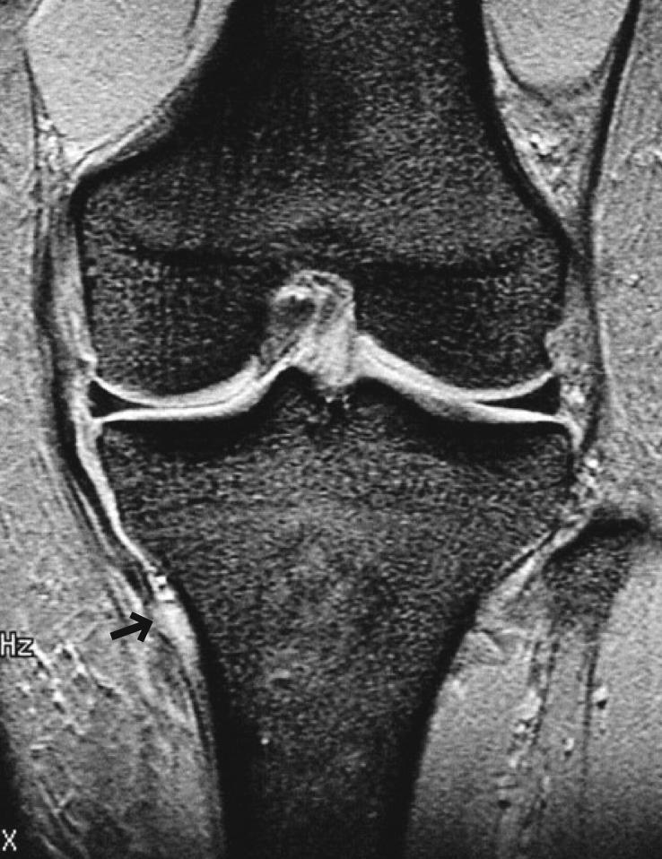 Collateral Ligaments and Posterior Corners MCL tear More than half of MCL tear occurs at the