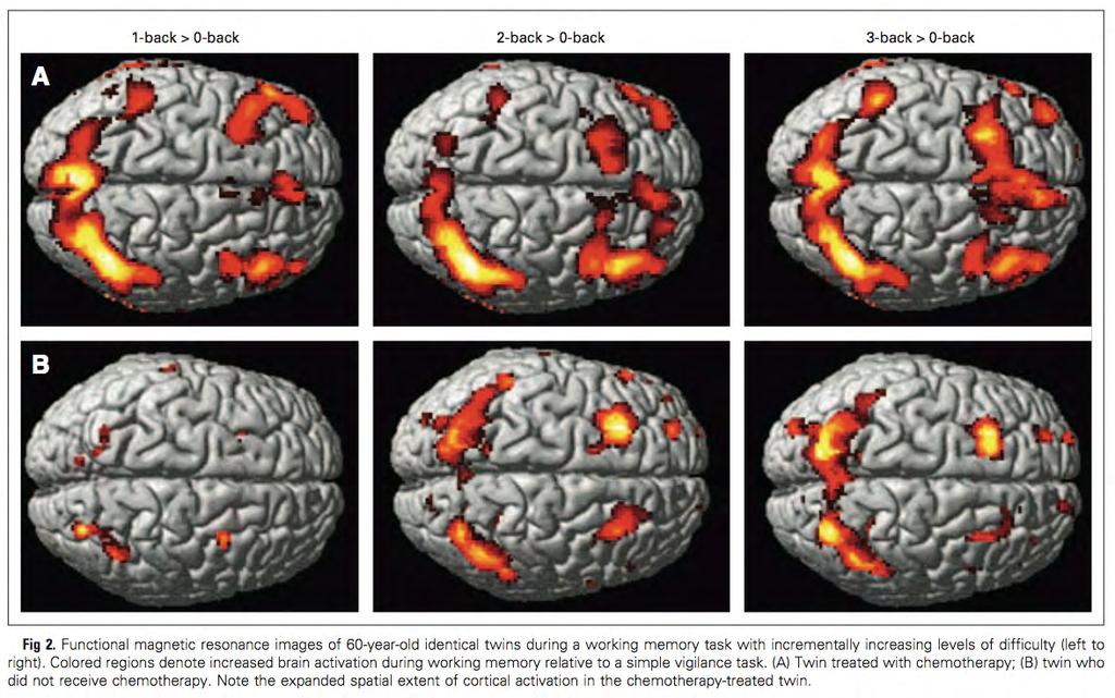 Twin A: More frontal and parietal activation during working