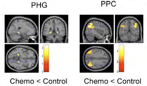 Posterior Hypoactivation (fmri) during Memory Encoding of Visual Paired Associates 10 Yrs after High Dose Chemo + Tamoxifen Ruiter et al. (2010) Vs.