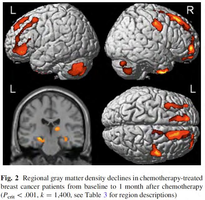Gray Matter Density (MRI) Decreases vs.