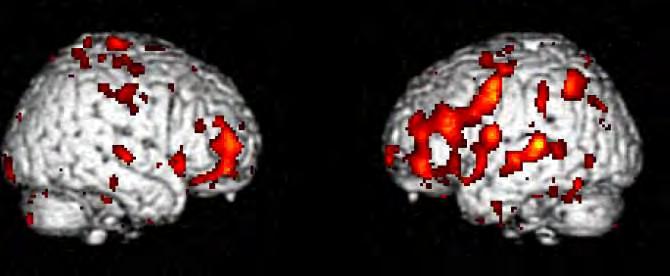 Chemotherapy Group at Baseline: Activation in Inferior Frontal Gyrus during Short-Term Memory Task SPM Largest cluster: Left Inferior Frontal Gyrus (2581 contiguous voxels at p<0.01; peak voxel t = 5.