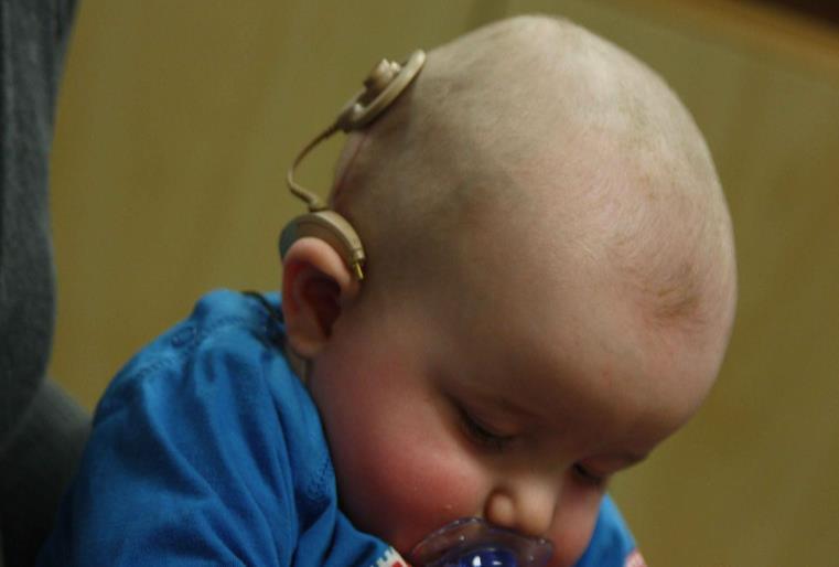 Audiological Interventions: Cochlear implant is a surgically implanted device that