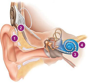 bypassing the damaged part of the cochlea, the cochlear implant uses its own