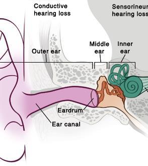 Type of Deafness Conductive hearing loss: results from abnormalities of the external ear and/or the ossicles of the middle ear. Sensorineural hearing loss: malfunction of inner ear structures (i.e., cochlea).