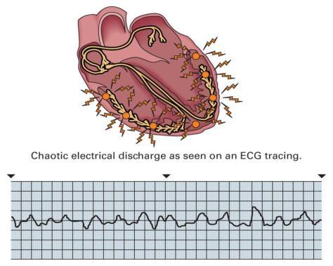 Analysis of Cardiac Rhythms Ventricular