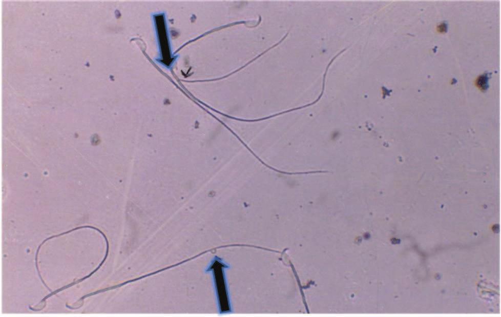 Male Reproductive System Plate 17: Sperm Abnormalities 1x X 4x i. A sperm with top shaped head.