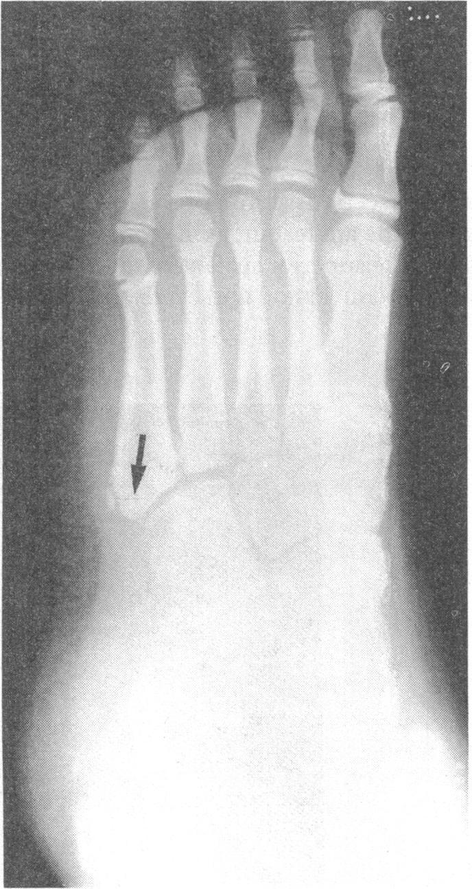 Right: Line diagram of radiograph showing Boehler's angle (dotted lines).