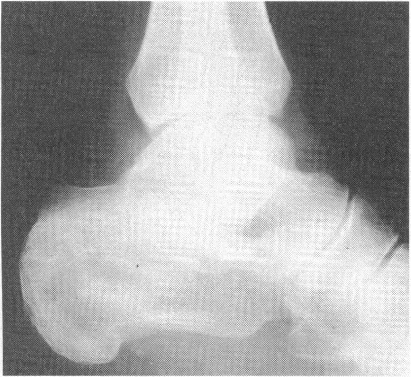 _ X.... - w.a. 0Z FIG 5-Lateral ankle radiograph showing linear fracture of the os calcis seen as a zone of radiolucency with reduction in Boehler's angle. w wx... w... s ::.. w. X Thoracolumbar fractures should be considered in unconscious patients who have fallen from a height on to their feet.