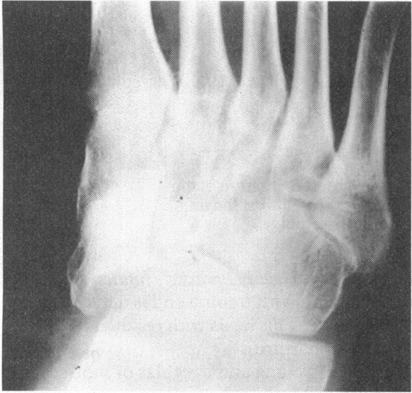 Boehler's angle is normally 25-40 ; an angle less than 250 indicates a depressed fracture of the subtalar portion of the calcaneus.