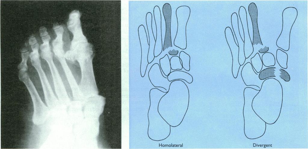 FIG Homolateral 8-Radiograph and line diagram showing types of Lisfranc injury. Divergent Thearea ofthefootmostoften injured intrauma totheankleisthebaseofthefifthmetatarsal(figs 1 and 4).