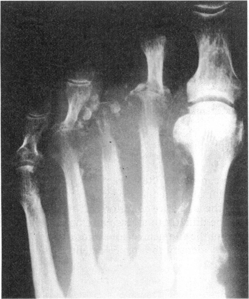 As this part of the foot is usually included in the lateral and anteroposterior ankle views further foot radiographs are often not necessary Fracture of the base of the fifth metatarsal results from