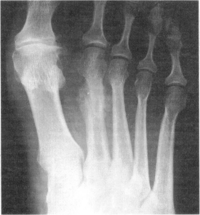 Metatarsal fractures are common and readily seen unless they are "stress fractures" (march) due to repeated subcortical trauma to a normal bone, usually the second metatarsal.