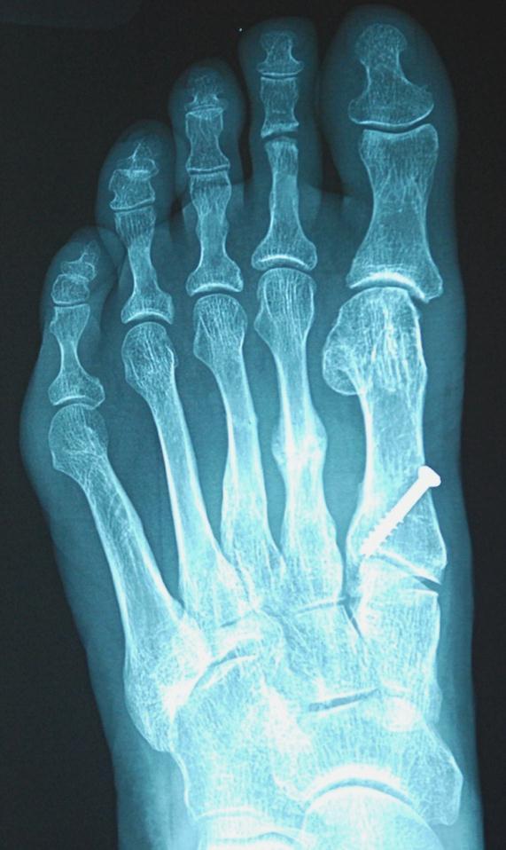 Case L (Figure 1): AP radiograph of 2 nd and 3 rd metatarsal stress
